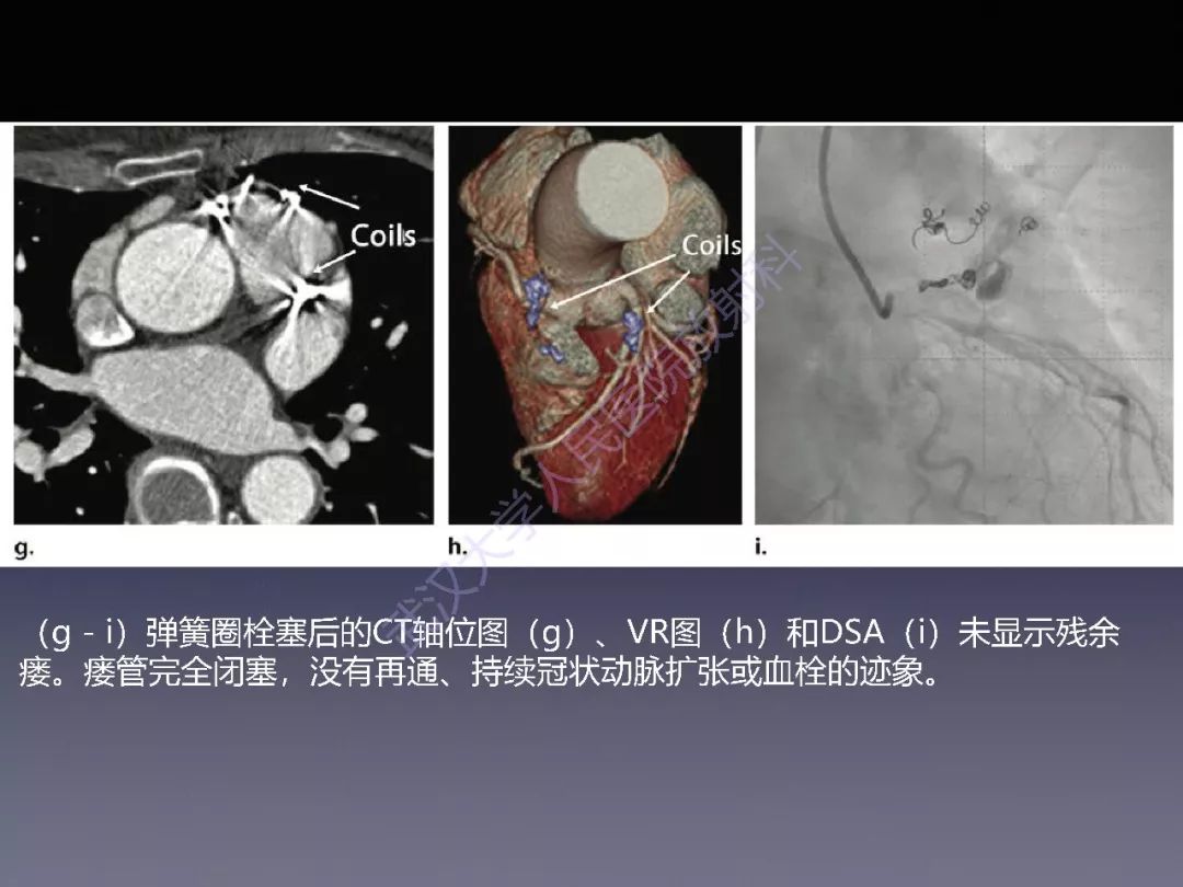 冠状动脉瘘:病理生理,影像表现及治疗