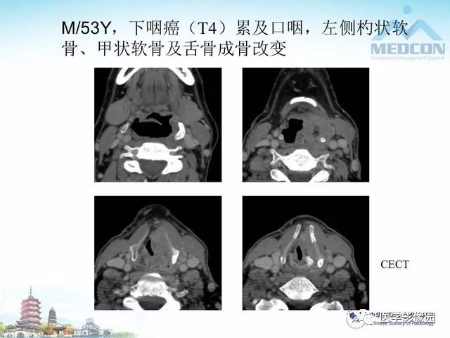 喉癌与下咽癌诊断,随访的影像学检查价值 | 影像天地