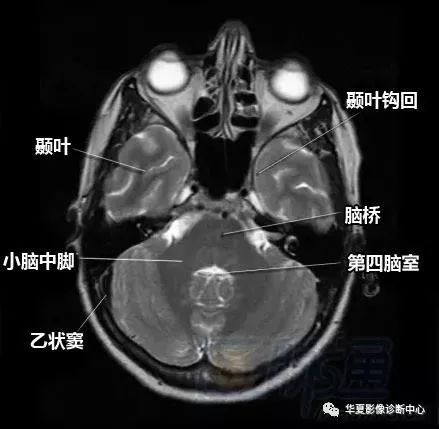 脑部断层 内囊 willis环 前联合 垂体 海马:清晰解剖