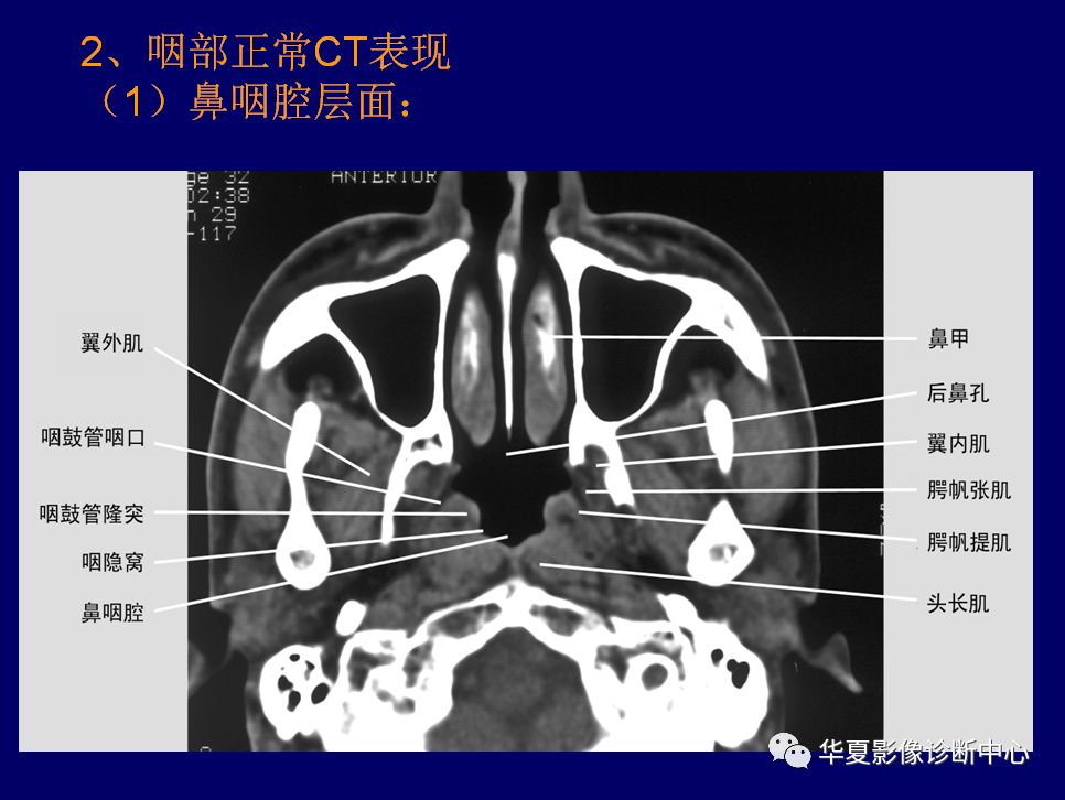 咽喉部影像诊断