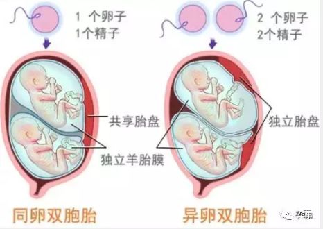 异卵双胞胎:两个卵被两个精子同时受精,产生异卵双胞胎.