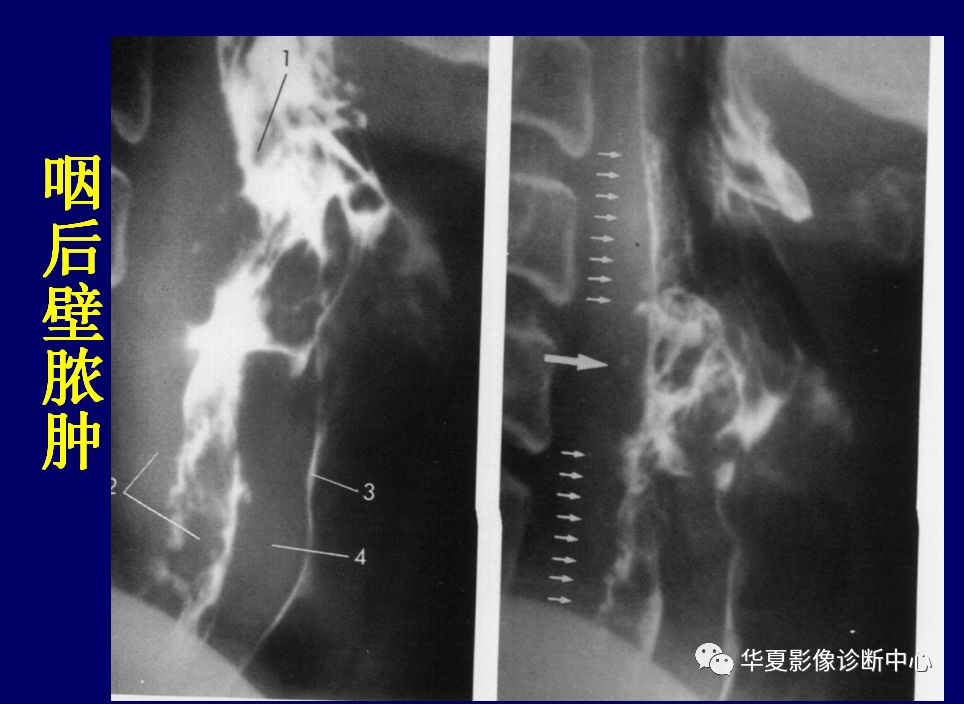 咽部解剖与疾病的影像诊断