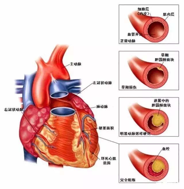 10.冠心病的病理基础