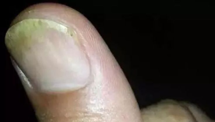 指甲上有竖条纹是肝不好?月牙越多越健康?关于指甲的2