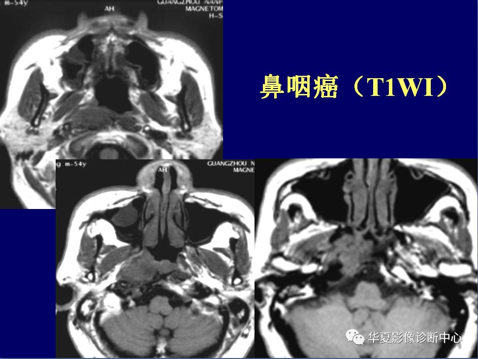 咽部解剖与疾病的影像诊断