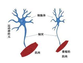 中医综合治疗运动神经元病