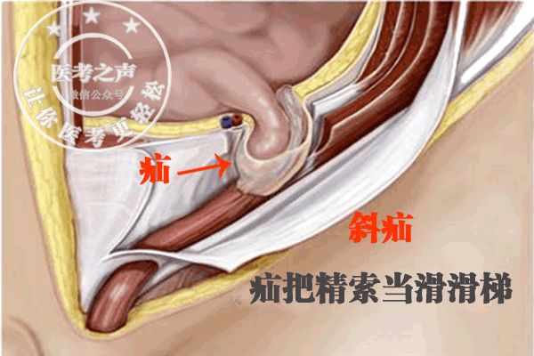 被挤成一个椭圆或者梨形 看图 大家想想 斜疝与精索位置关系是怎样?