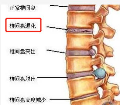 脊椎老化怎么办