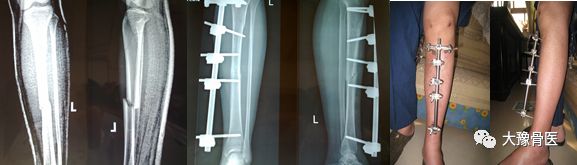 闭合复位微创外固定架固定治疗开放性胫骨干骨折