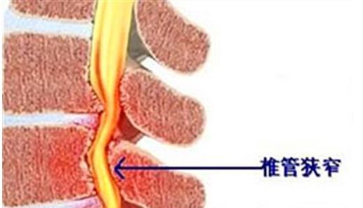 脊椎老化怎么办