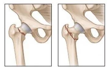 为什么老年人的髋部骨折会要了患者的命?