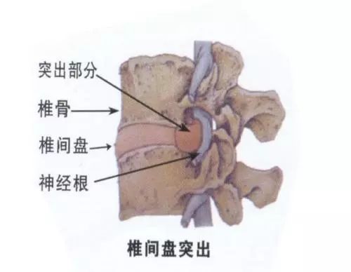 脊椎老化怎么办