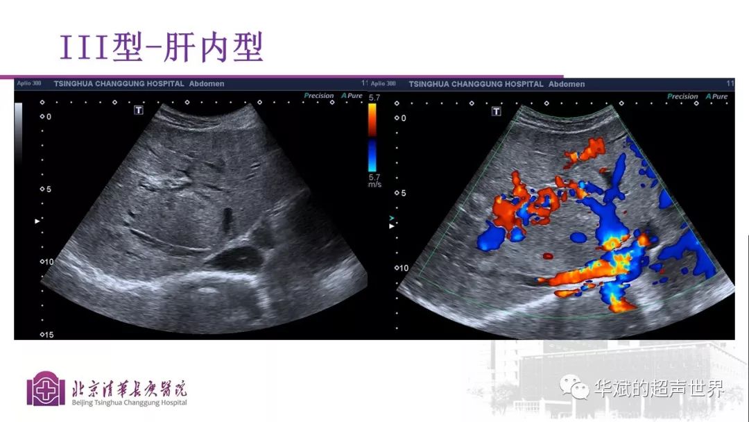 文献和病例学习:门静脉海绵样变性