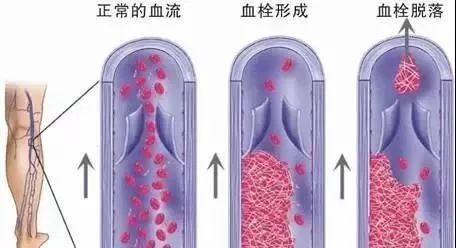 脚上的青筋突出怎么办