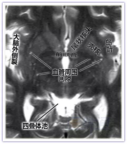 简明易懂的脑部断层解剖图谱,快来收藏!