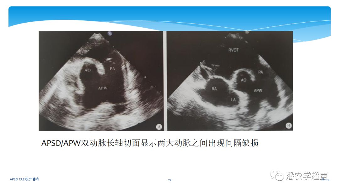 【超声微课堂】主动脉肺动脉间隔缺损经胸超声心动图