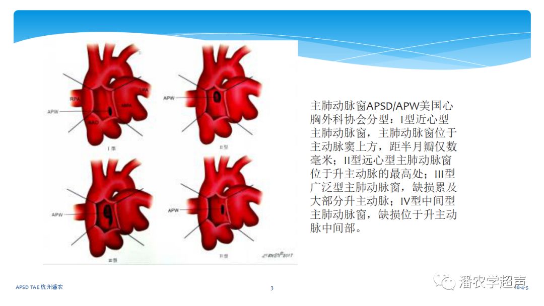 【超声微课堂】主动脉肺动脉间隔缺损经胸超声心动图