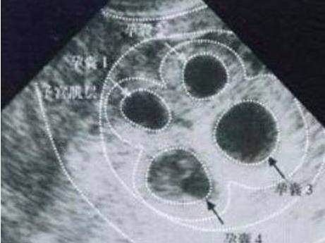 女孩怀孕五个月肚子异常大,到医院检查后,丈夫直接瘫软在地