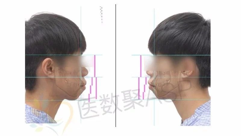 数字化手术辅助设计在双颌前突治疗中的应用