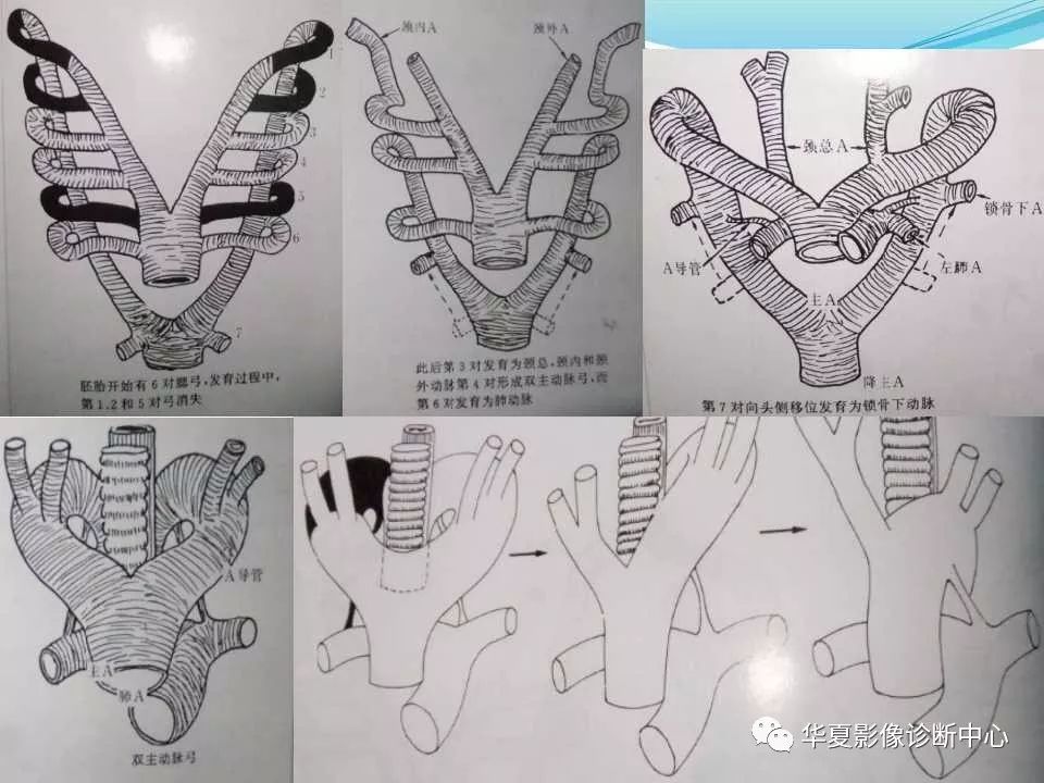 【影像基础】主动脉弓及其主支的先天畸形