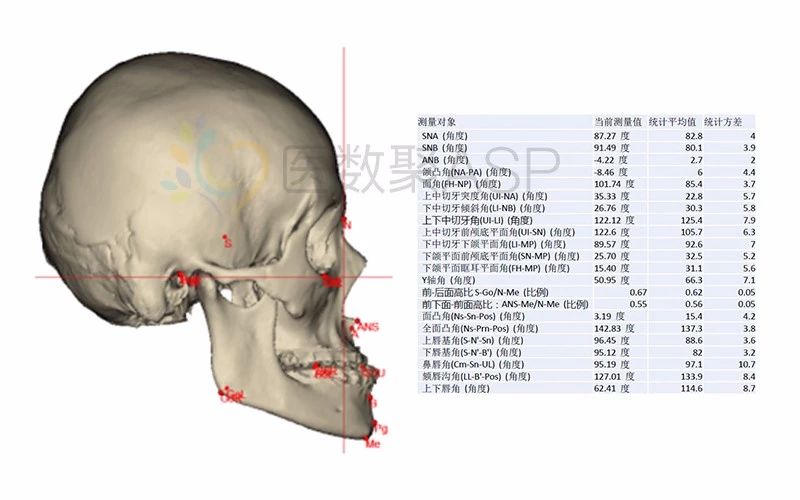 医数聚asp对患者头颅进行三维重建,精准测量相关数据