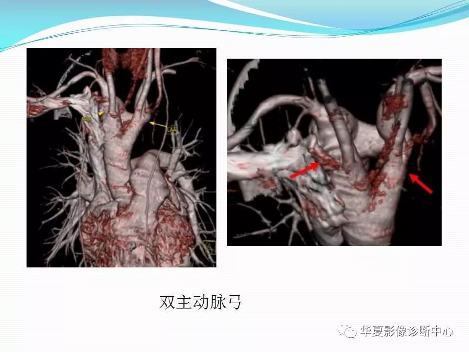 【影像基础】主动脉弓及其主支的先天畸形