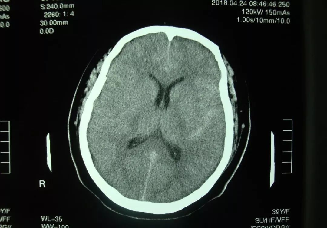 图1 头颅ct平扫:可见左外侧裂及纵裂少量蛛网膜下腔出血.