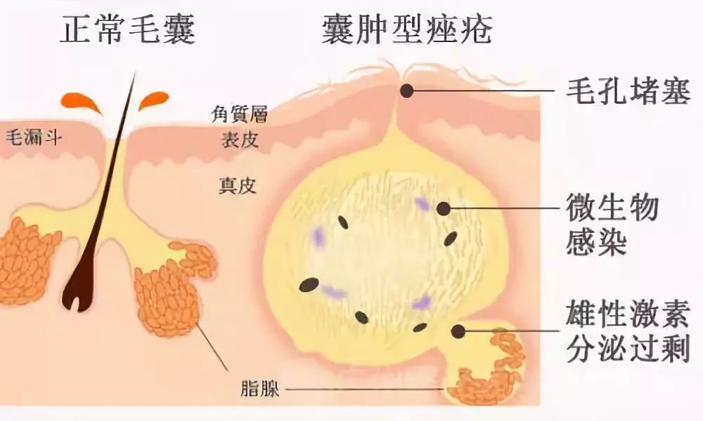 因为这些都是可以加重皮脂腺分泌的食物,所以饮食要注意清淡,多吃