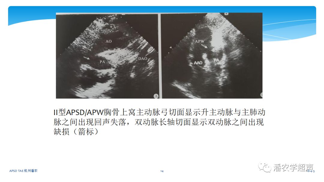 【超声微课堂】主动脉肺动脉间隔缺损经胸超声心动图