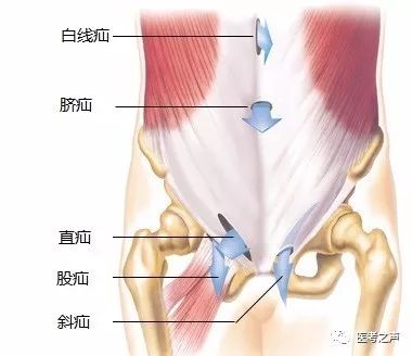 腹股沟解剖 和 腹股沟疝 ,学医这么多年终于搞懂了!