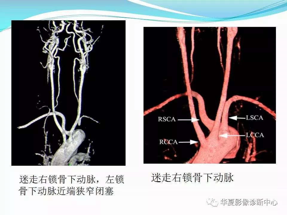 【影像基础】主动脉弓及其主支的先天畸形