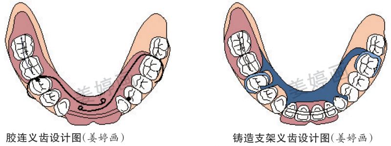 铸造支架可摘局部义齿修复设计,这些要点你注意到了吗