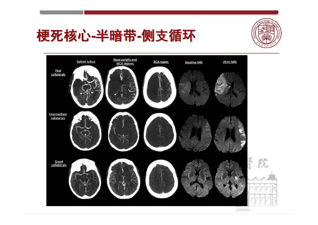 精彩幻灯 漫谈脑梗死的影像学评估