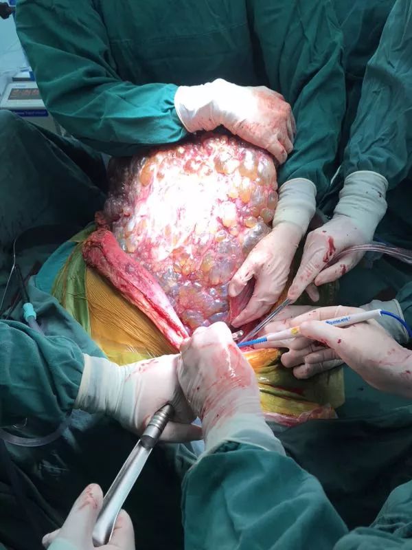 2018年1月2日,由郑树森院士主刀为朱老师行肝移植手术,切开腹部时