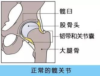 这样的结构可以使股骨头稳稳地深嵌在髋臼窝中(见上图).