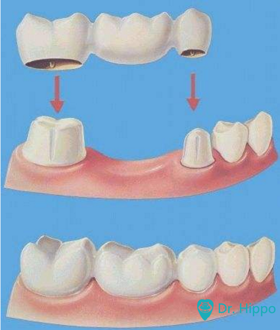 固定义齿与活动义齿相比的优点