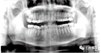 上颌结节区罕见多生牙2例