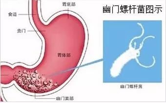 中国一半人口感染胃癌细菌_胃癌手术伤口感染病人(2)