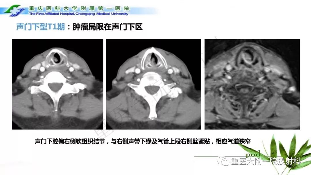 喉部解剖及t分期影像诊断