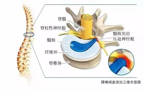 腰椎间盘突出是什么原因?