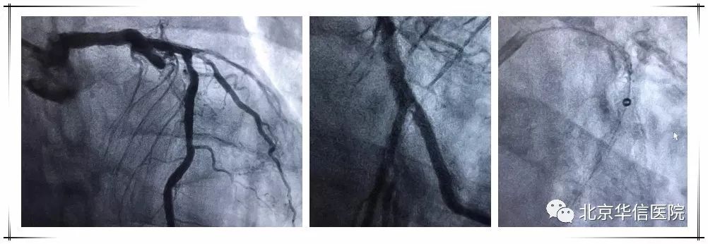 北京华信医院心脏中心成功开展准分子激光冠脉内斑块消蚀术治疗复杂