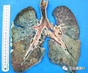 警惕肺纤维化危及生命