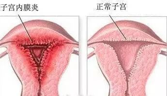 荆州东方妇科医院 ▏女性出现这些异常要当心,恐是子宫内膜炎来袭!