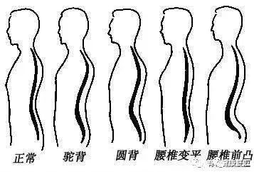 除正常体态外,其余腰椎患者不适合燕飞锻炼