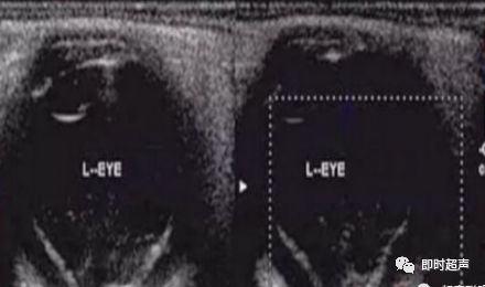 视网膜囊肿—— 【超声表现】