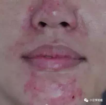 春季是皮肤过敏高峰期,脸上的突然过敏不能归咎于护肤