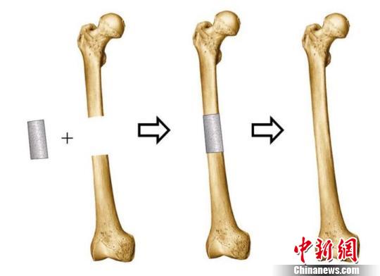 组织工程骨损伤修复再生模式.医院提供