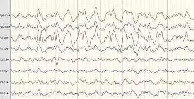 脑电图,也就是eeg(英文全名electroencephalogram的缩写),是通过仪器
