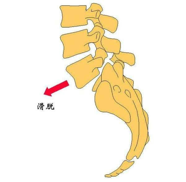 其实你只要记住腰椎滑脱就是椎体之间失去了正常的位置关系,某一椎体