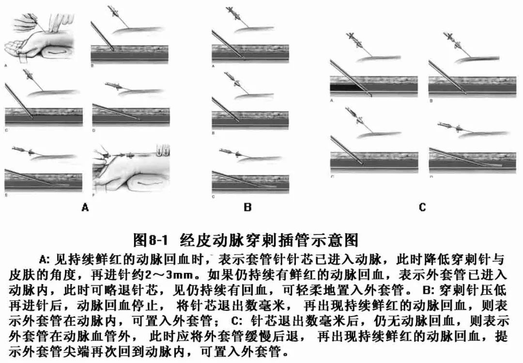 指南共识桡动脉穿刺置管操作与压力监测的专家共识最新